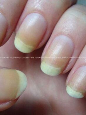 Discoloured Nails? Try these 10 DIY hacks that actually work 25 cropped image 2025 07 23782b4b3ffe294314da09619e3fdec9